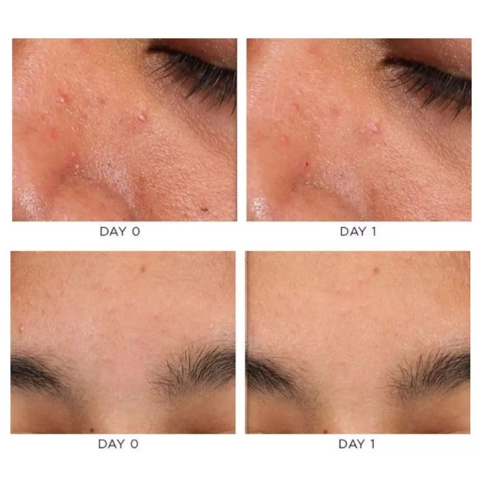 ACCELERATE ADVANCED SPOT TREATMENT, Ночной точечный уход от высыпаний, Osmosis, 5 ml